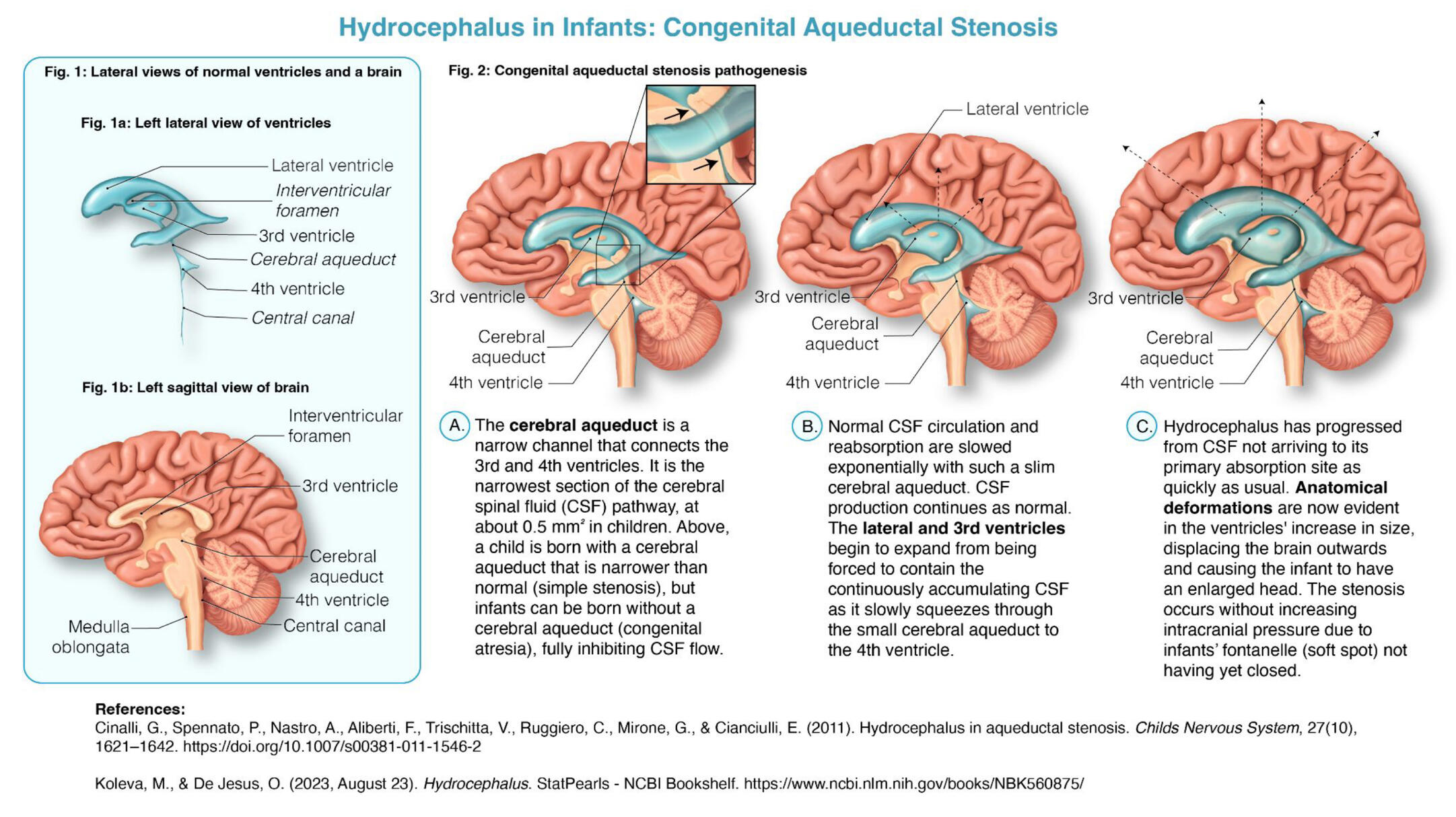 Pathophysiology of Hydrocephalus in Infants – Adobe Illustrator, Procreate; Rochester Institute of Technology; Medical Illustrator Puerto Rico