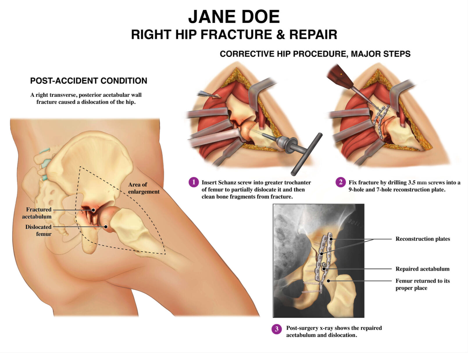 Medical Legal Jane Doe Case – Adobe Photoshop, Illustrator; Rochester Institute of Technology; Medical Illustrator Puerto Rico