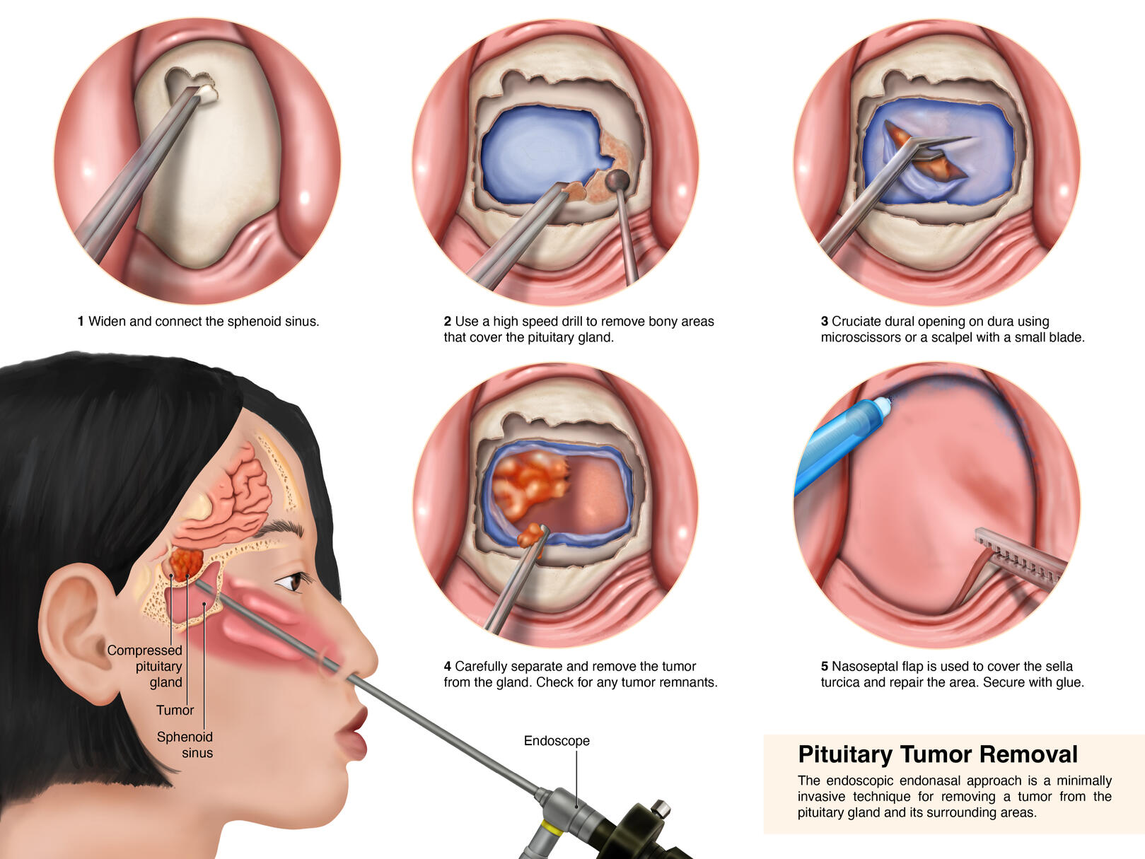 Pituitary Tumor Removal Surgical Series – Adobe Photoshop, Illustrator; Rochester Institute of Technology Surgical Illustration; Medical Illustrator Puerto Rico