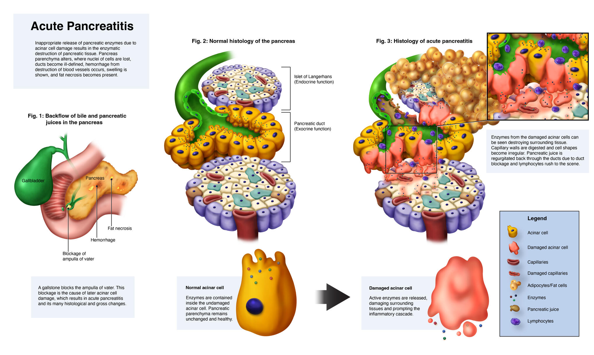 Histopathology of Acute Pancreatitis – Clip Studio Paint EX, Adobe Illustrator; Rochester Institute of Technology Medical Illustration; Medical Illustrator Puerto Rico