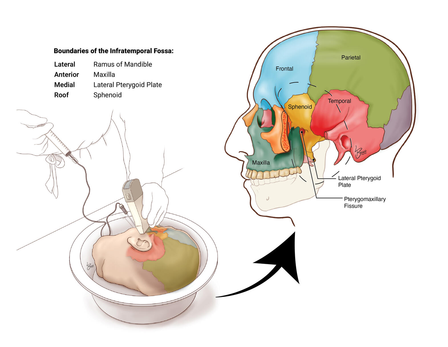 Boundaries of the Infratemporal Fossa – Clip Studio Paint EX, University of Puerto Rico's School of Medicine; Recinto de Ciencias Médicas Ilustración Médica; Medical Illustrator Puerto Rico