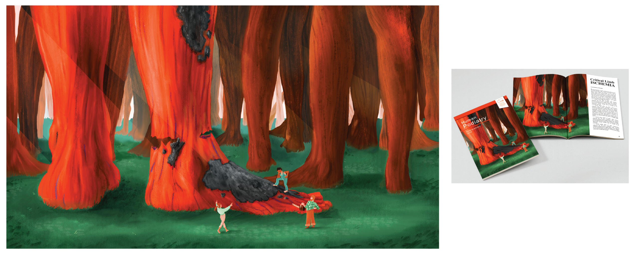 Critical Limb Ischemia Editorial Illustration – Procreate